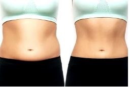 Lipotropic Injections in Abu Dhabi Before and After