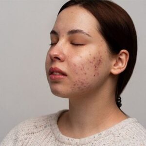 Blog 1 Microneedling for Acne Scars Cost in Abu Dhabi