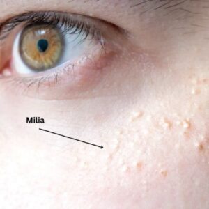 Blog 1 Milia Treatment Cost in Abu Dhabi