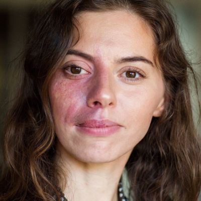 Port Wine Stains Removal Cost in Abu Dhabi 2 Port Wine Stains Removal Cost in Abu Dhabi