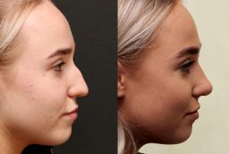 Silicone Nose Surgery in Abu Dhabi before and after