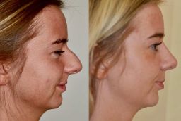 before and after Silicone Nose Surgery in Abu Dhabi