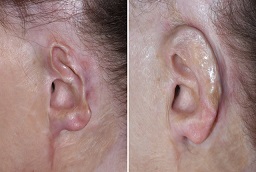 Burn Reconstructive Surgery in Abu Dhabi before after