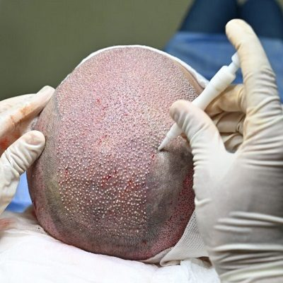 DHI Direct Hair Implant Cost In Abu Dhabi 2 DHI Direct Hair Implant Cost In Abu Dhabi