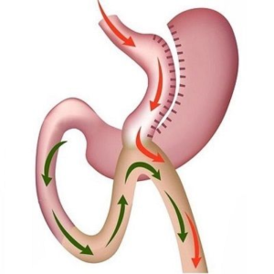 Gastric Bypass Cost In Abu Dhabi