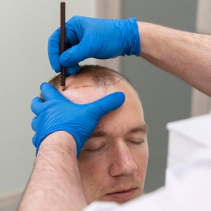 Blog 1 Hybrid Hair Transplant Cost In Abu Dhabi