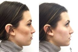 Jawline Treatment 8 Jawline Treatment in Abu Dhabi before after