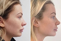 Jawline Treatment in Abu Dhabi before and after