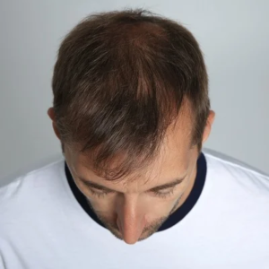Blog 1 Scarless Hair Transplant Cost In Abu Dhabi