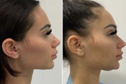 before and after Jawline Treatment in Abu Dhabi
