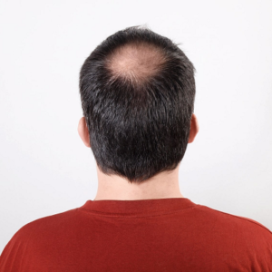 Blog 5 Crown Hair Transplant Cost In Abu Dhabi