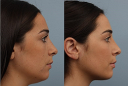Double Chin Removal Before and After