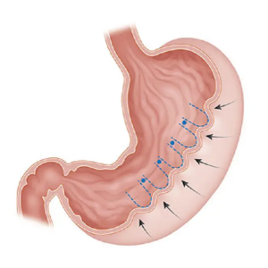 Blog 3 Endoscopic Sleeve Gastroplasty Cost In Abu Dhabi