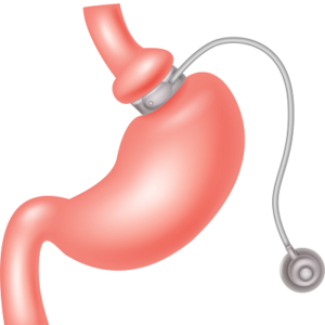 Blog 1 Gastric Banding Cost In Abu Dhabi