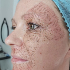 Blog 1 Plasma Pen Treatment Cost In Abu Dhabi