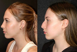 Before and After Cheek Augmentation