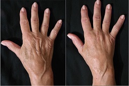 Before and After Hand Rejuvenation with Fat Transfer