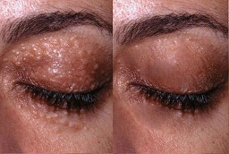Before and After Milia Treatment