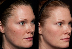 Redermalization Treatment 8 Before and After Redermalization Treatment