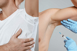 Before and After Botox Injections for Sweaty Glands transformed