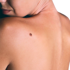 Benign Mole Removal Treatment Cost In Abu Dhabi