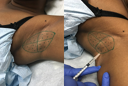 Botox Injections for Sweaty Glands Before and After