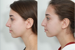Cheek Augmentation After and Before