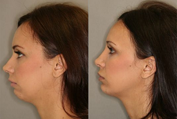 Cheek Augmentation Before and After