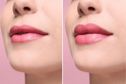 Fotona 4D Lip Augmentation After and Before