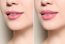 Fotona 4D Lip Augmentation Before and After