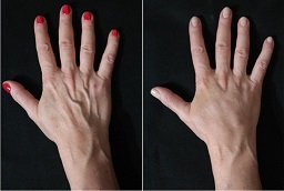Hand Rejuvenation with Fat Transfer After and Before