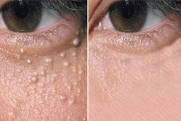 Milia Treatment After and Before