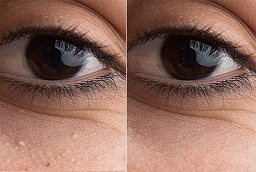 Milia Treatment Before and After