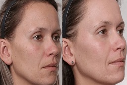 Redermalization Treatment After and Before