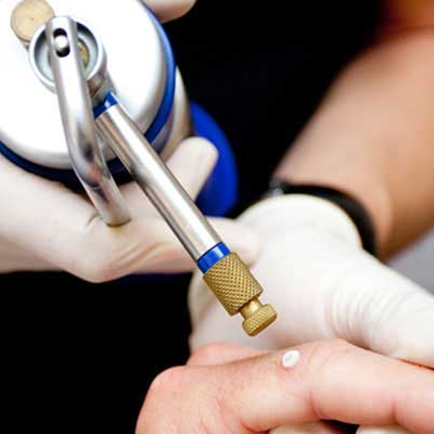 Cryosurgery – Cryotherapy Cost In Abu Dhabi