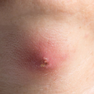 Blog 1 Incision and Drainage of Abscesses Cost in Abu Dhabi