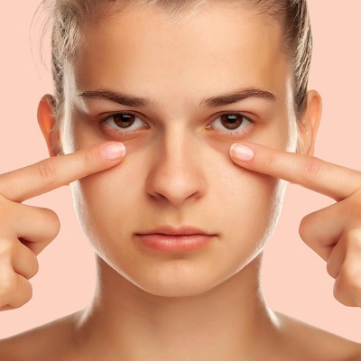 Does Microneedling Work For Dark Circles