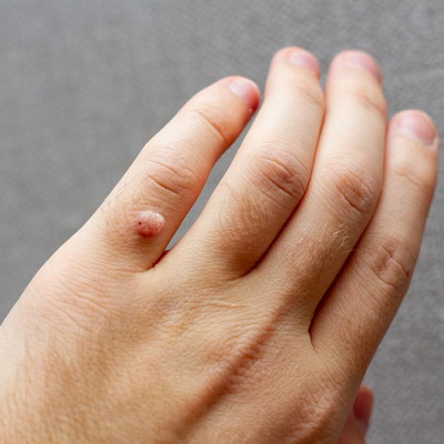 Get Rid of Warts With Most Effective Ways