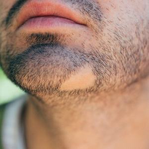 Blog 11 How To Fix Bald Spots In Your Beard