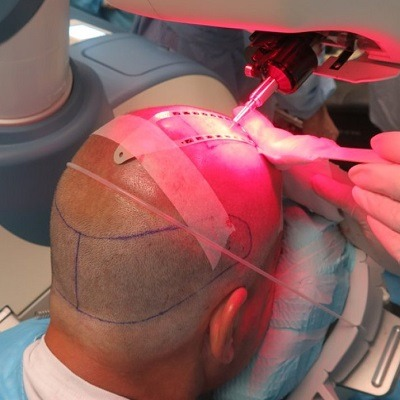 Robotic Hair Transplant Cost In Abu Dhabi