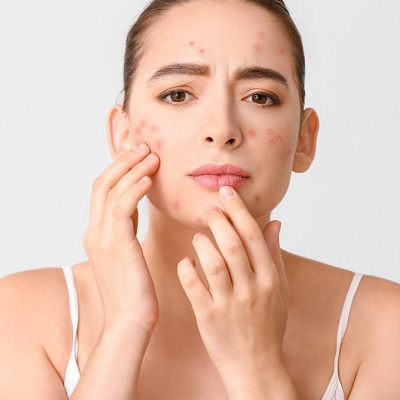 Best Acne Treatment in Abu Dhabi & Al Ain | Face Acne Cost UAE