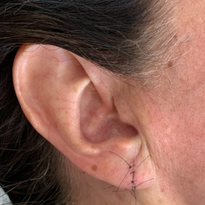 Blog 11 Can a Ripped Earlobe be Repaired