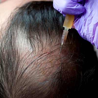 Does PRP Work for Alopecia? 4 Does PRP Work for Alopecia?