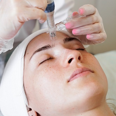 Does RF Microneedling Melt Fat