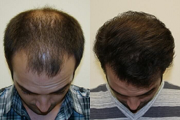 Before and After Fuss Hair Transplant