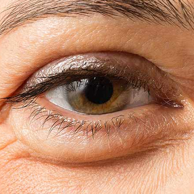 Effective Ways to Eliminate Under-Eye Bags and Puffiness