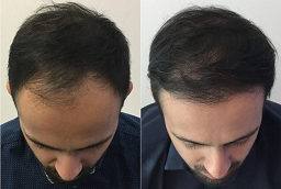 Fuss Hair Transplant After and Before