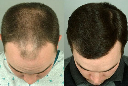 Fuss Hair Transplant Before and After