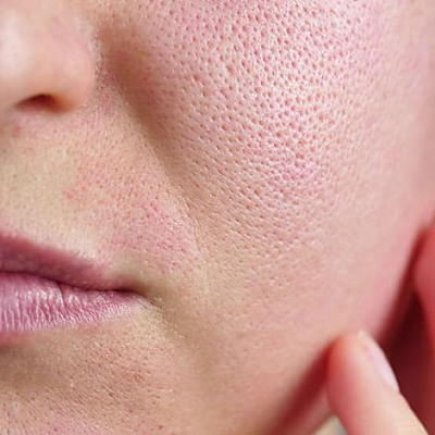 How To Close Pores Permanently?