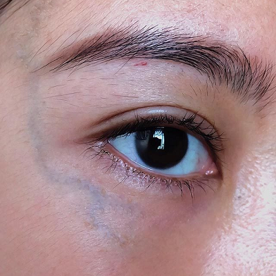 How to Get Rid of Under Eye Veins